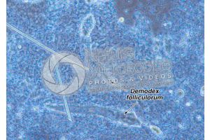 Demodex folliculorum. Demodectic mange. 100X