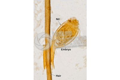 Pediculus humanus capitis. Head louse. Nit. Pediculosis. 40X