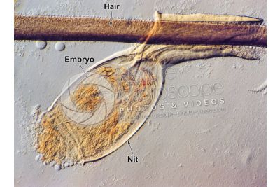Pediculus humanus capitis. Head louse. Nit. Pediculosis. 100X